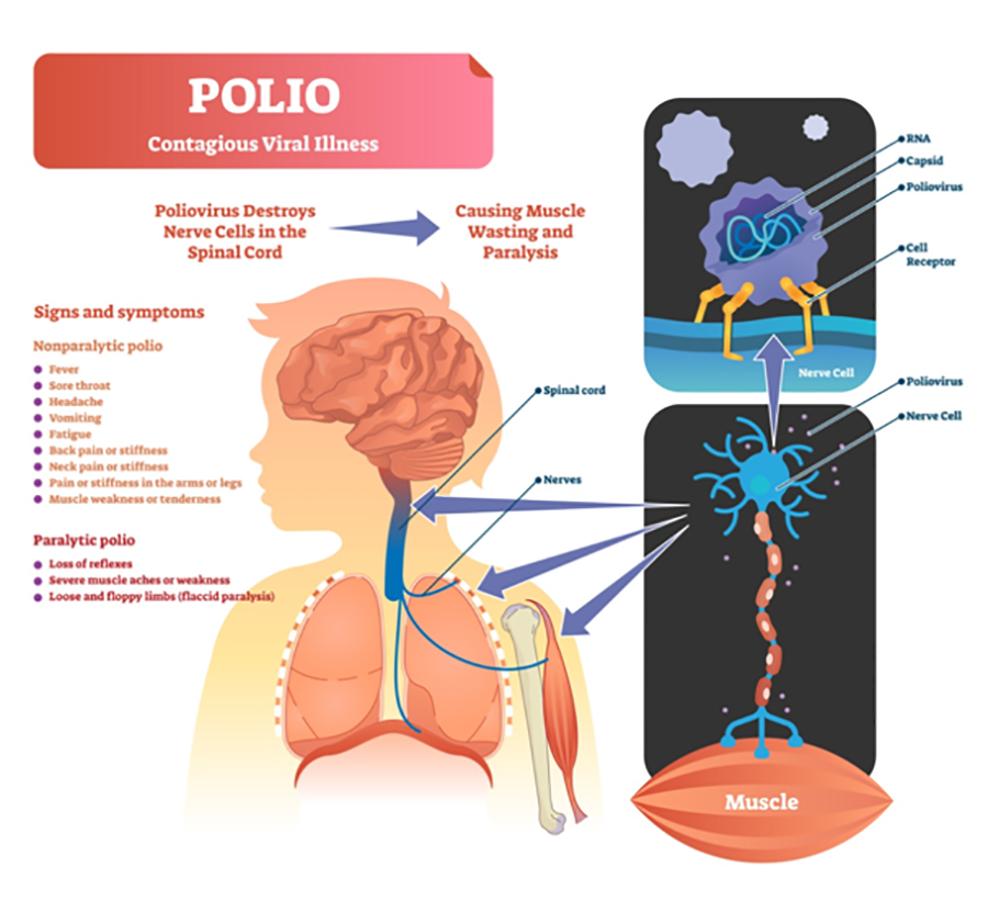 Polio Image